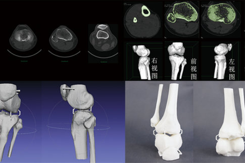 CT數(shù)據(jù)三維重建骨骼模型，骨骼模型精細化建模修復(fù)，骨骼模型3D打印快速成型