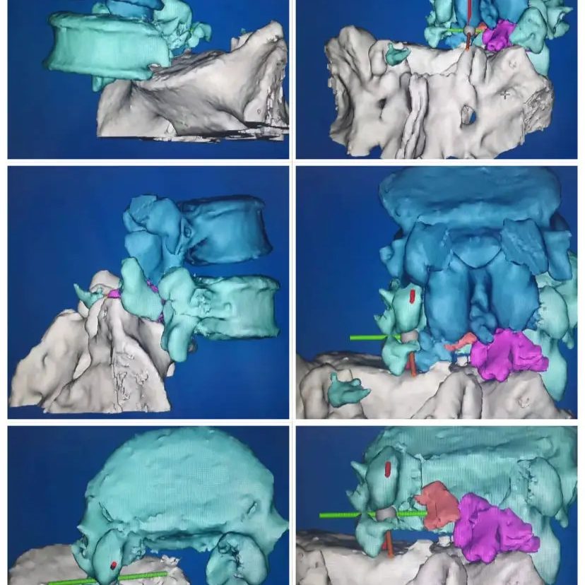 3D打印制作脊柱模型，可以讓更加直觀(guān)、立體地了解患者的病情，并制定相應(yīng)的手術(shù)方案或者矯正治療方案。.webp