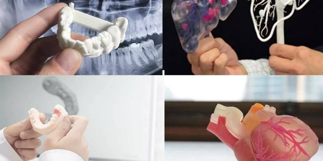 CT數(shù)據(jù)三維重建，醫(yī)學(xué)3D打印技術(shù)在骨科中的具體應(yīng)用